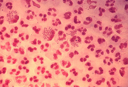 Gonorrhoea infection images