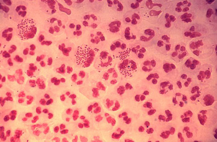 Gonorrhea infection images