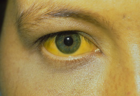 Assessment of jaundice images