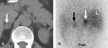 Evaluation of incidental adrenal mass images