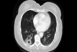 Systemic vasculitis images