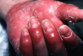 Psoriatic arthritis images