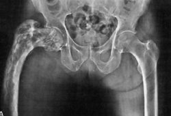 Paget's disease of bone images