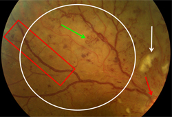 Retinopatia diabética images