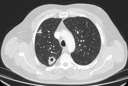 Evaluation of solitary pulmonary nodule images