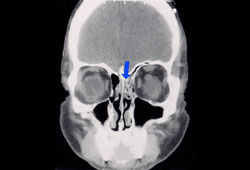 Assessment of olfactory loss images