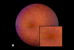 Age-related macular degeneration images