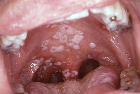 Infecção pelo vírus da imunodeficiência humana (HIV) images