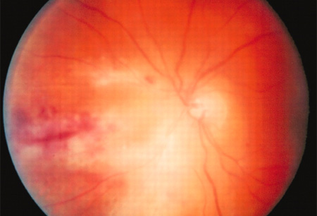 Cytomegalovirus infection images