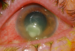 Keratitis images