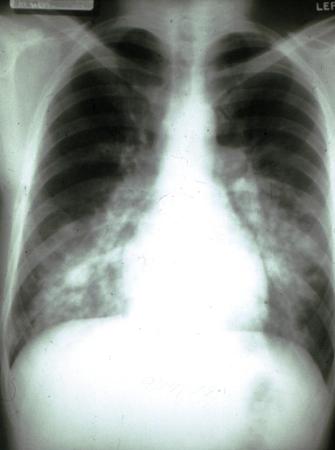 High altitude illness images