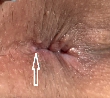 Anal fissure images