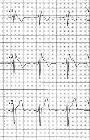 Evaluation of palpitations - Differentials | BMJ Best Practice US