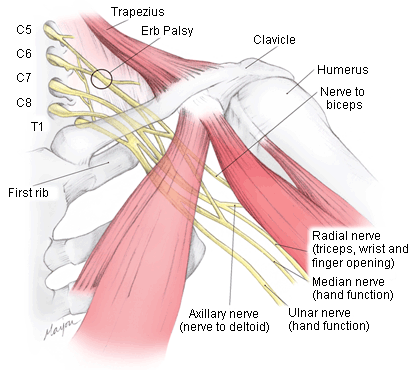 Lésion du plexus brachial