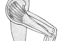 Iliotibial band syndrome images