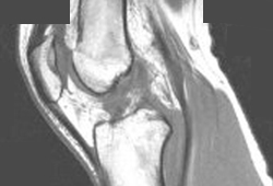 Anterior cruciate ligament injury images