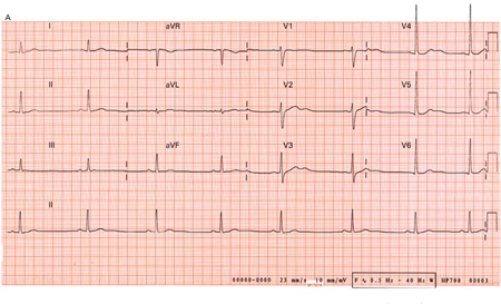 Assessment Of Hypokalaemia - Differential Diagnosis Of Symptoms | BMJ ...