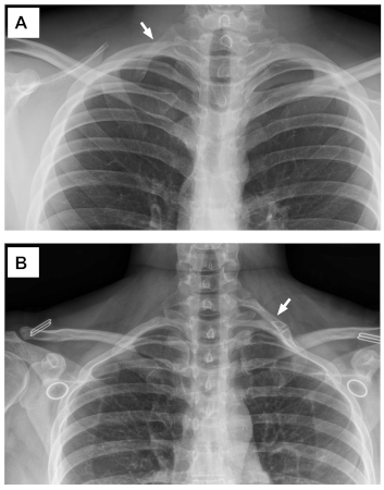 Thoracic outlet syndrome images