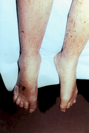 Complex regional pain syndrome images