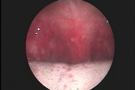 Tonsillitis images