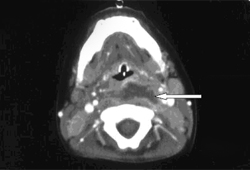 Retropharyngeal abscess images