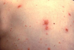 急性水痘带状疱疹 images