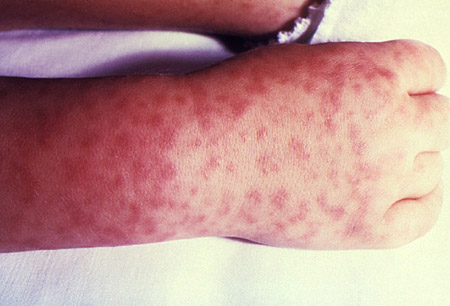 Rocky Mountain spotted fever images