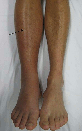 Avaliação do edema periférico images
