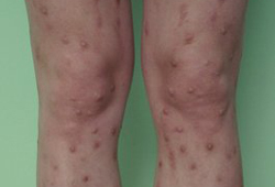 Assessment of pruritus images