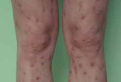 Evaluation of pruritus images