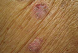 Actinic keratosis images