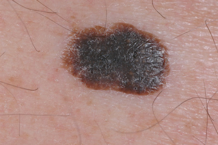 Seborrheic Keratosis Electrocautery, 👉🏻What is seborrheic keratosis? 📌A  seborrheic keratosis (seb-o-REE-ik ker-uh-TOE-sis) is a common noncancerous  skin growth. People tend to get more of, By Nature of Skin