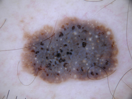 seborrheic keratosis dermoscopy