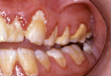 牙龈炎 images
