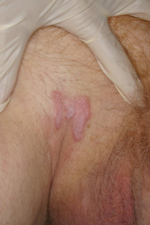 Lichen planus images