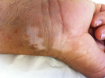 Vitiligo images
