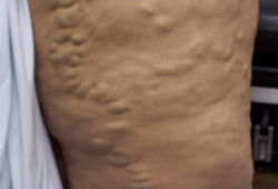 Varicose veins images