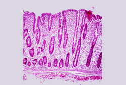 Celiac disease images