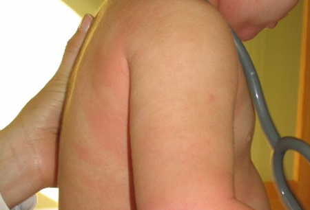 Food allergy images