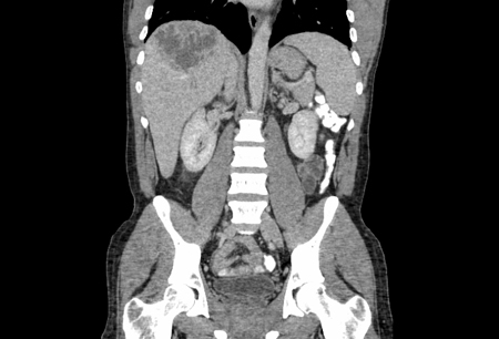 Liver abscess images