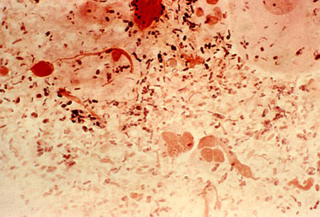 Assessment of proctitis images