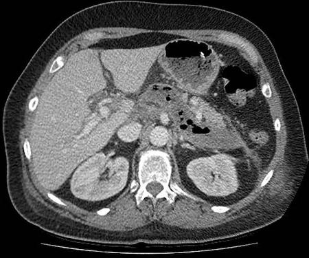 Acute pancreatitis - Management Approach | BMJ Best Practice US