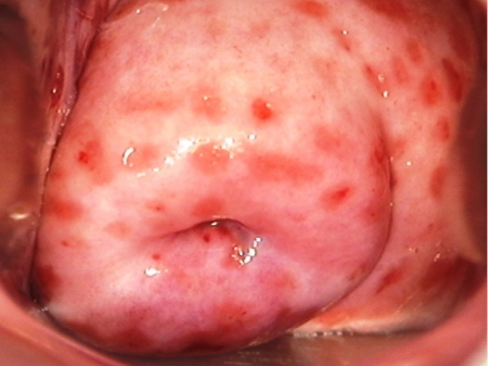 Cervicitis images