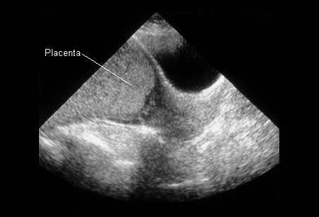 Placenta previa images