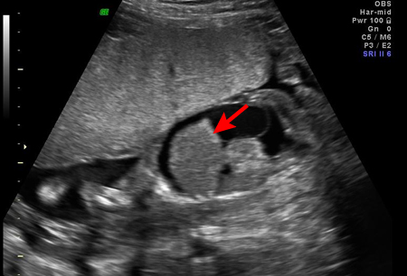 Rh incompatibility images