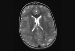 Tuberous sclerosis complex images