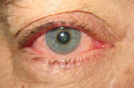 Acute Conjunctivitis - Symptoms, Diagnosis And Treatment | BMJ Best ...