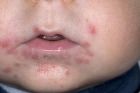 Hand-foot-and-mouth disease images