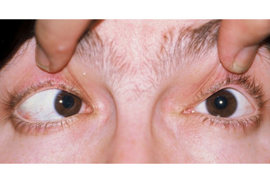 Strabismus images