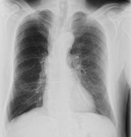 Enfermedad pulmonar obstructiva crónica (EPOC) images